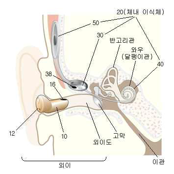 뉴로바이오시스의 인공 와우 장치