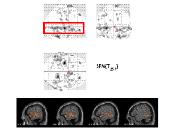 비정상적인 활성화 패턴을 보여주는 Block 실험 디자인의 fMRI 분석 결과