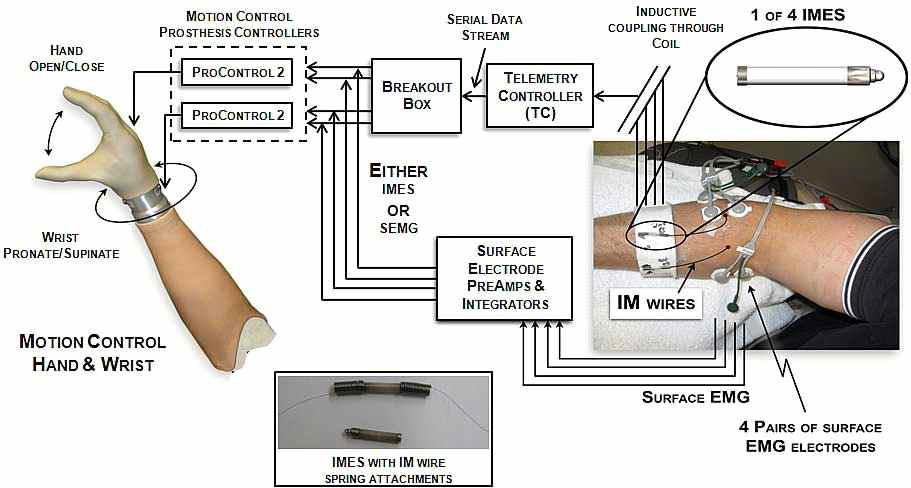 인공팔의 움직임 제어를 위한 삽입된 IMES시스템 블록선도
