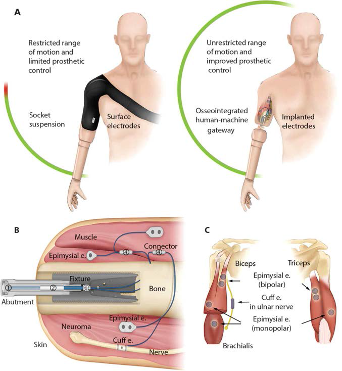 인공팔의 신경 제어 기술 개요: (A) 전통적인 소켓 vs. OHMG, (B) 보철 팔 부착물, (C) 우측 위쪽 팔의 근외막과 cuff 전극의 위치