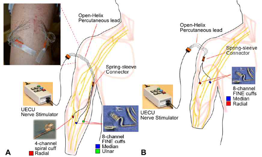 피험자 1의 전완과 피험자 2의 상완 중간에 이식된 신경 커프 전극.