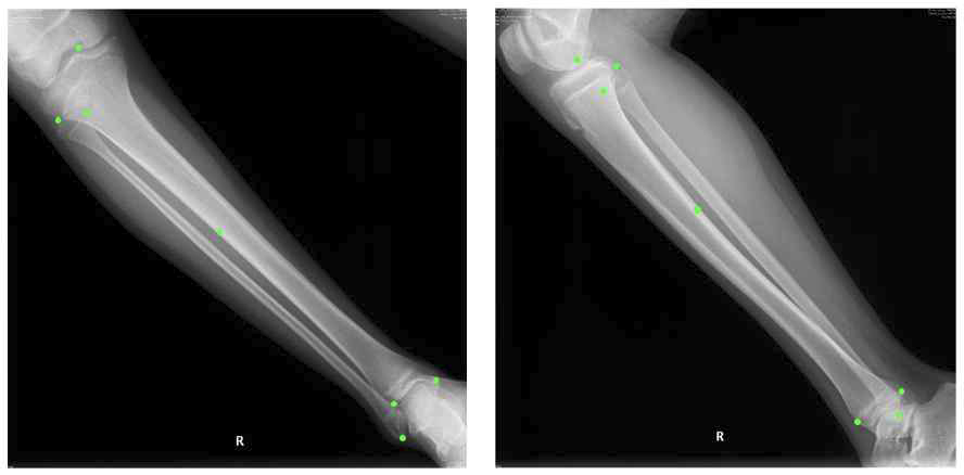 사용자로부터 입력 받은 X-ray 상의 점.