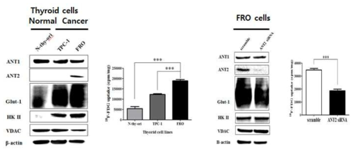 갑상선 종양 세포에서의 ANT2 발현 및 18F-FDG 섭취 비교