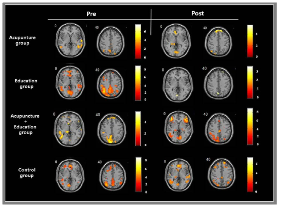 교육, 침, 교육+침 자극의 효과에 대한 fMRI 연구 결과