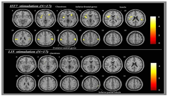신문혈과 양계혈 자극에 의한 뇌활성화