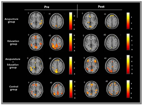 각 처치집단별 처치 전후의 뇌활성화 차이