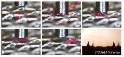 마이크로니들의 부착층을 부분적으로 녹이는 방법(partially melt)을 이용한 마이크로니들의 메쉬로 의 장착 과정 이미지.