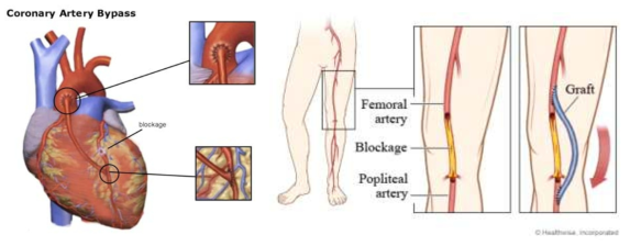 좌측 그림은 심장동맥경화(coronary atherosclerosis) 그리고 우측그림은 말초동맥경화 (peripheral atherosclerosis)로 인한 혈관 이식편(vascular graft)을 이용한 우회로 수술(bypass surgery)을 보여줌.