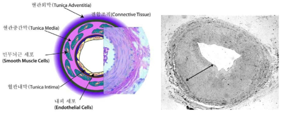 좌측 그림은 정상상태의 혈관의 단면 구조를 보여줌. 혈관내막(tunica intima), 혈관 중간막(tunica media), 그리고 혈관외막(tunica adventitia)의 세 가지 층으로 구성되어있음. 우측 그림은 혈관내막의 세포이 상 증식(neointimal hyperplasia)으로 인한 협착(stenosis)이 일어난 정맥이식편(vein graft)을 보여줌(화살표 표시부분)