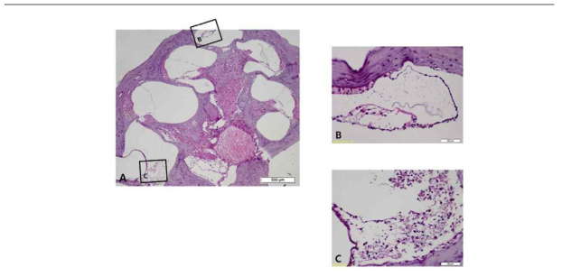 달팽이관 속 외림프 공간의 염증 반응 여부 확인을 위한 조직학 검사결과