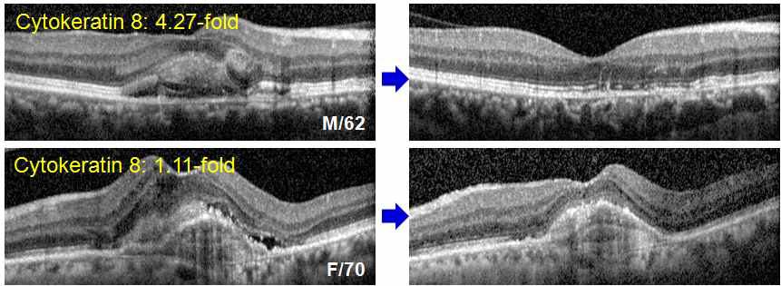 좌측은 치료전의 OCT 사진, 우측은 ranibizumab 유리체강내 주사 1달후의 OCT 사진임.