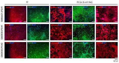 당뇨 환자 특이적 역분화 줄기세포부터 유도된 베타 세포 분화 유도의 마커 발현 검증