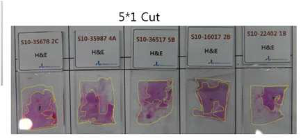 병리학자에게 의뢰한 tumor area 표시 slide 사진