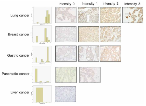 한국인 암 환자조직에서의 anti-VSIG4 Ab의 IHC 결과 및 면역점수 분포