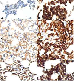 다발골수종에서 VSIG4 단백질 발현 양상