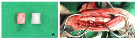 The normal radius (left) and a three-dimensional PLGA/HAp nanofiber (right) (A), an intraoperative view of a radius defect (B).