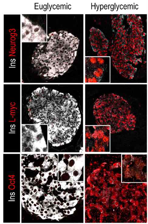 Beta cell dedifferentiation(역분화).