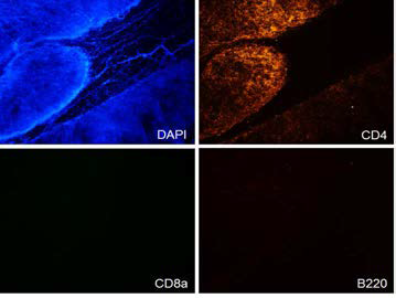 흉선종 이식으로 발생한 암 조직 침윤 및 주변부에 위치한 임파구 면역세포의 분석