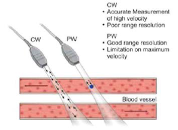 펄스파/연속파 도플러 차이점