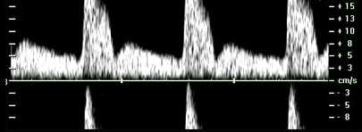 펄스파 도플러 aliasing