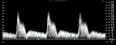 연속파 도플러 non aliasing