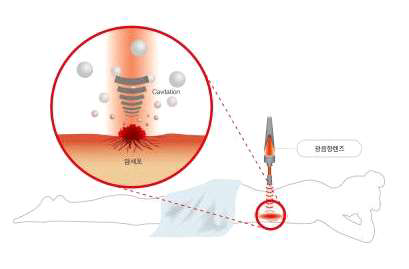 광음속 수술 나이프의 원리