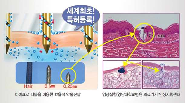 무통증 주사기 ‘태피 톡톡’