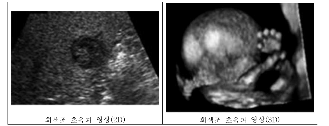 회색조 초음파 영상