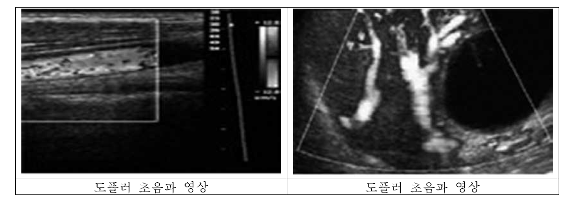 도플러 초음파 영상