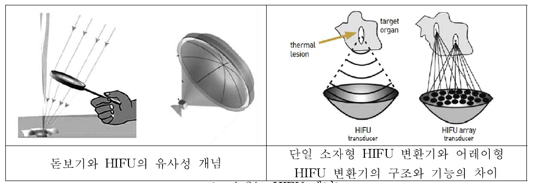 HIFU 개념