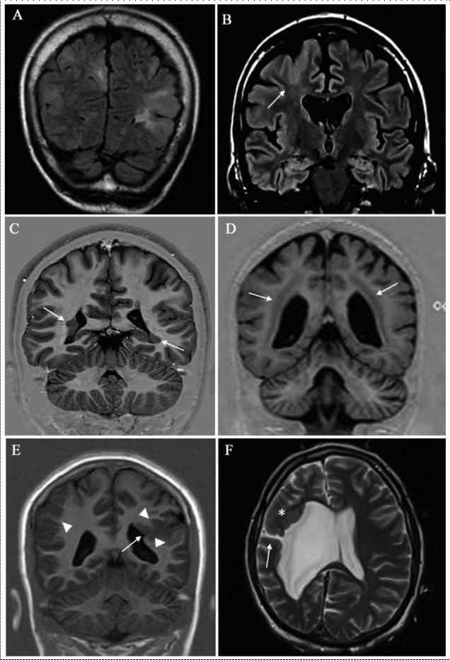 대뇌 피질 형성 장애로 인하여 관찰되는 다양한 형태의 MCD를 보여주는 Brain MRI 사진