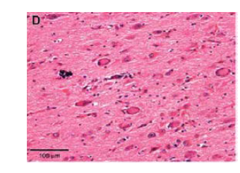 Cytomegalic neuron 들이 정상세포에 둘러싸여 소량으로 존재하는 것을 보 여주는 MCD 환자의 뇌조직 H&E staining 사진