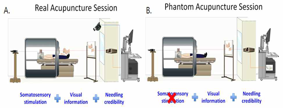 진짜침 (Real acupuncture, REAL)과 가짜침 (Phantom acupuncture, PHNT)의 구성요소