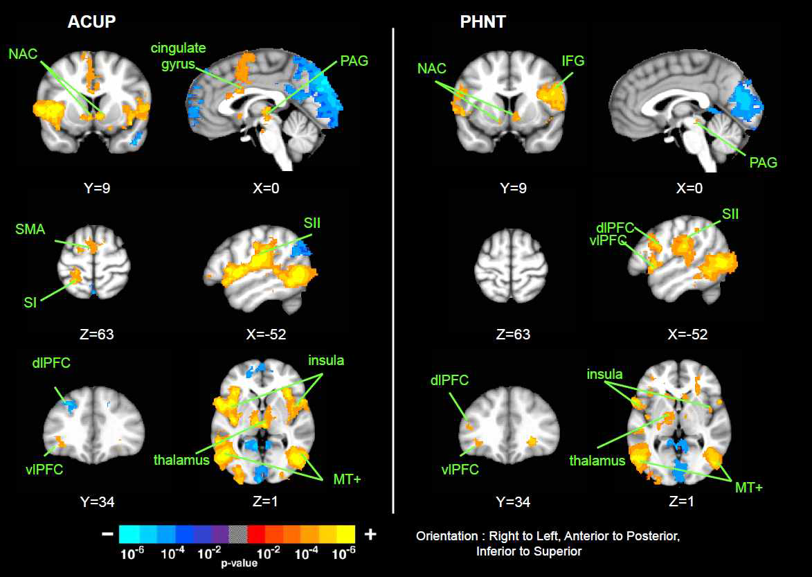 진짜침과 가짜침군의 침자극에 대한 뇌활성반응 지도