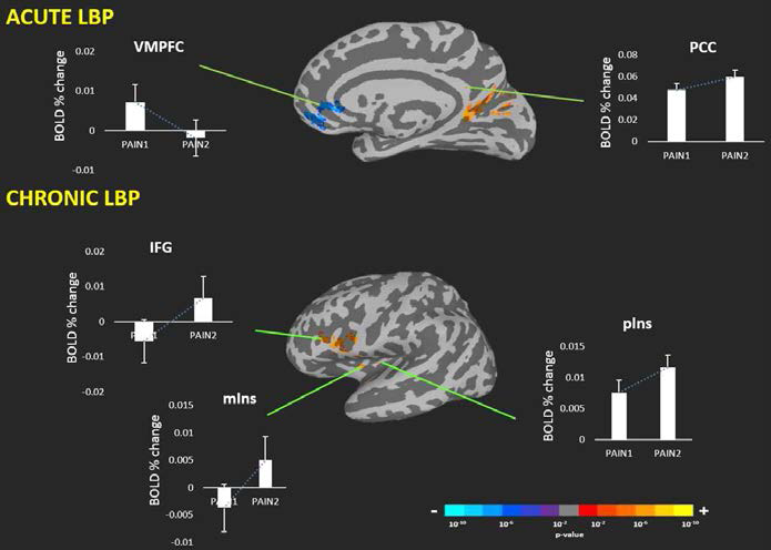 급성과 만성 요통환자군의 Default mode network의 연결상태 변화