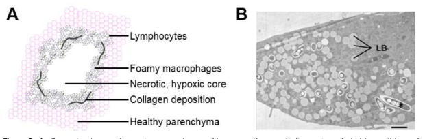 A. General scheme of a mature granuloma, with a necrotic core in its center, circled by a ribbon of immune cells, including lymphocytes in the outer part and foamy macrophages in the inner side. B. Electron microscopy view of a foamy macrophage infected with M. avium.