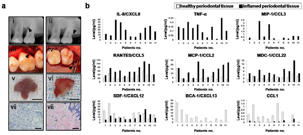 사람의 건강한 치주 조직 및 염증성 치주 조직에서의 periodontal tissue-specific chemokine expression 분석