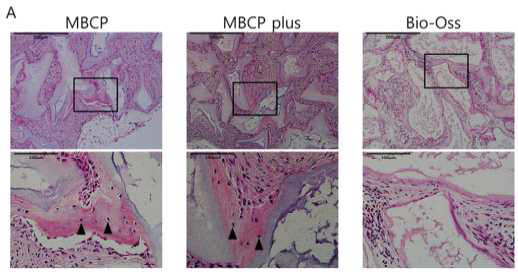 MBCP그룹에서는 우수한 골재생이 형성되나 Bio-oss에서는 골 유도 현상이 없음