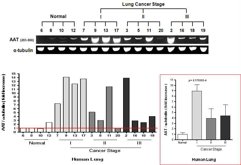 폐암환자샘플을 대상으로 alpha I-Antitrypsin (AAT)의 부분 RNA 발현양 비교