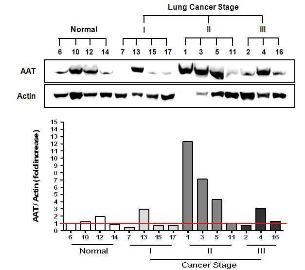 폐암환자샘플을 대상으로 alpha I-Antitrypsin (AAT)의 전체 RNA 발현양 비교