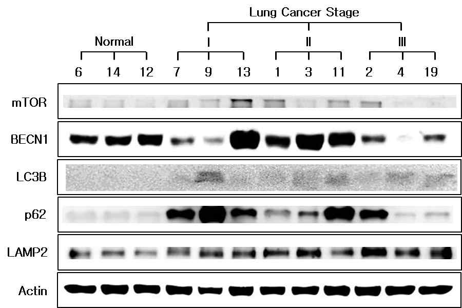 폐암환자샘플을 대상으로 자가포식관련 단백질의 발현양 비교