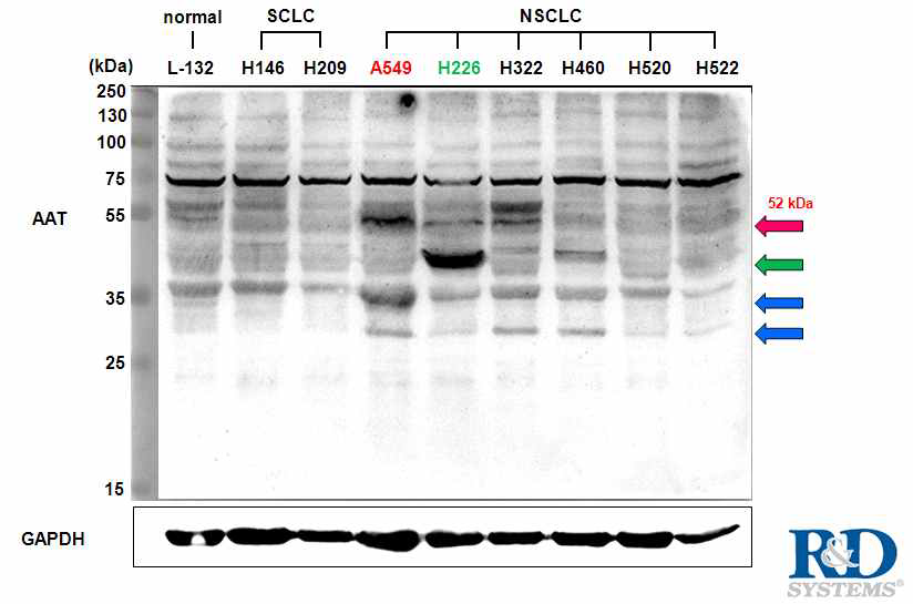 다양한 폐암세포주를 대상으로 alpha I-Antitrypsin (AAT)의 단백질 발현양 비교