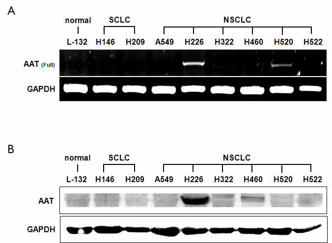 다양한 폐암세포주를 대상으로 alpha I-Antitrypsin (AAT)의 전체 RNA 및 단백질 발현양 비교