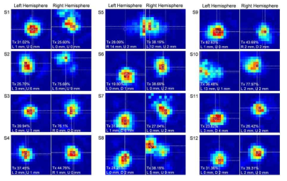 감각보고 12명 피험자 각각의 좌반구 우반구 초음파 자극에 대한 음파 시뮬 레이션 결과.