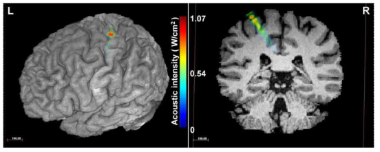 촉감각생성 집중초음파 실험에 참여한 건강한 피험자 중 한명 S1에 대해 음 파 시뮬레이션 결과를 피험자의 anatomical MRI 영상에 기반하여 렌더링한 3차원 뇌와 Coronal view 상에 Overlay한 결과.