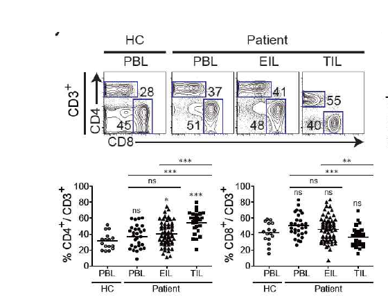 암 조직과 체액, PBMC에서의 T 세포 아형 분석
