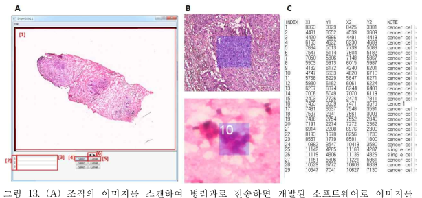 (A) 조직의 이미지를 스캔하여 병리과로 전송하면 개발된 소프트웨어로 이미지를 열어 암세포의 위치를 마킹한다; (B) 마킹된 영역의 모습; (C) 마킹된 영역에 대한 위치 데이 터를 전송받아 분리를 하게 됨.