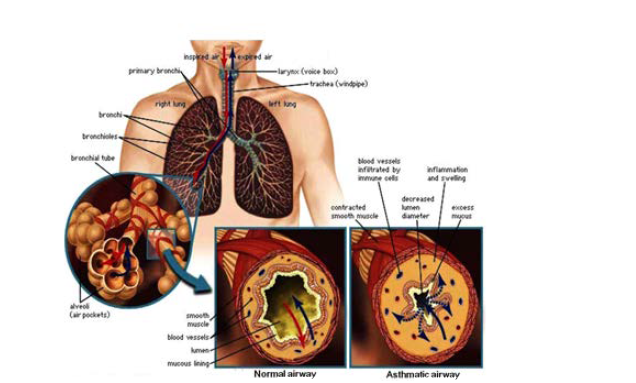 천식에서의 기도 모양