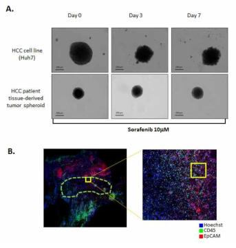 간암세포주와 간암환자 유래 일차 배양 간암세포를 이용하여 형성한 스페로이드에 서의 약물 민감성 비교(A) 및 그림1-A의 환자 조직의 구성 요소를 형광면역 염색(CD45, EpCAM)으로 확인함.