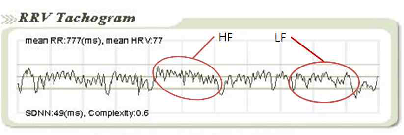 5분간 측정한 R-피크 간의 변화양상